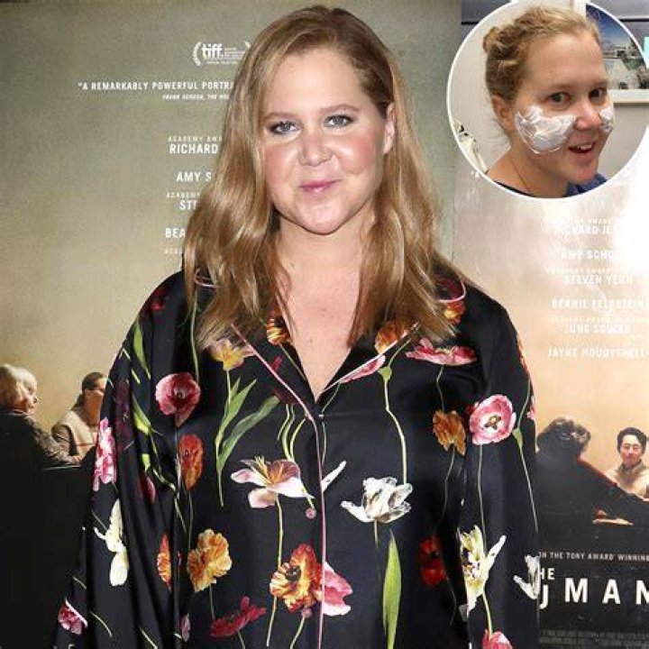 Amy Schumer Dissolves Fillers After Plastic Surgery Procedure: ‘I Looked Like Maleficent’