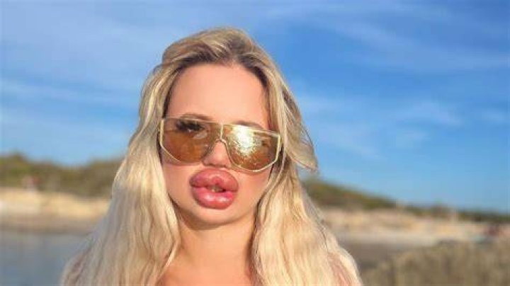 Jessy Bunny after breast enhancements and lip surgeries