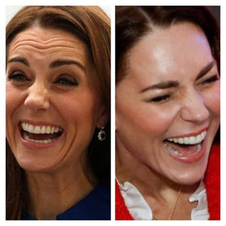 Kate Middleton smiling botox