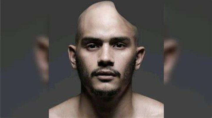 Kiko Matos deformed head