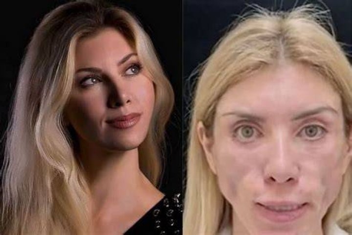 Yulia Tarasevich underwent plastic surgery